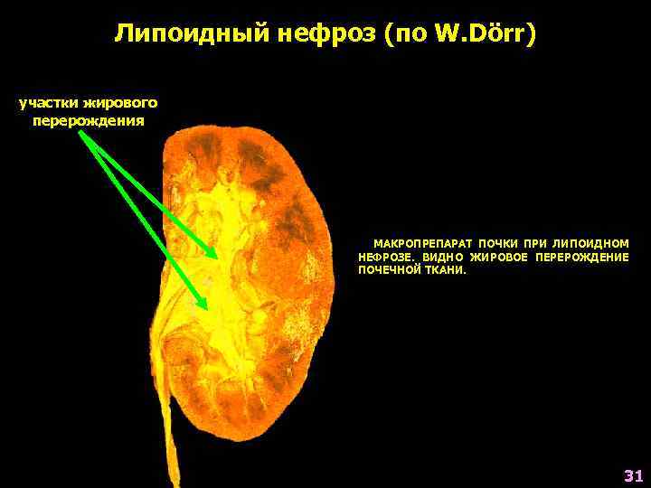 Жировое перерождение тканей