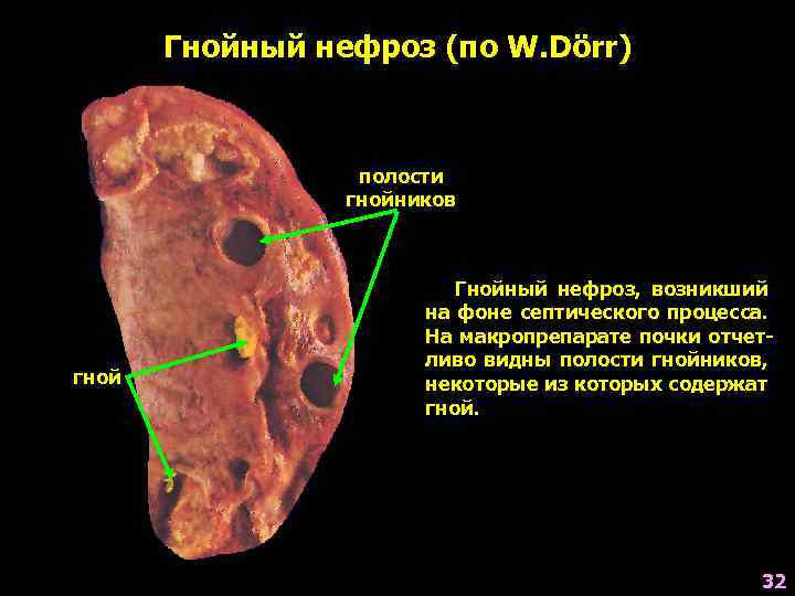 Гнойный нефроз (по W. Dörr) полости гнойников гной Гнойный нефроз, возникший на фоне септического