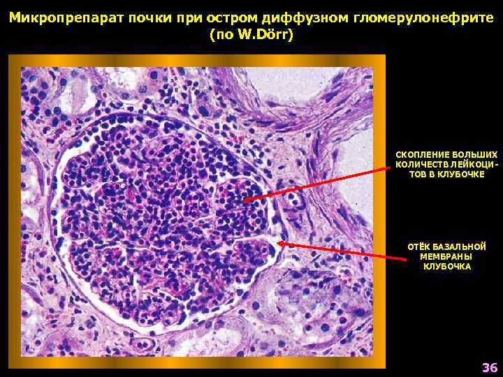 Микропрепарат почки при остром диффузном гломерулонефрите (по W. Dörr) СКОПЛЕНИЕ БОЛЬШИХ КОЛИЧЕСТВ ЛЕЙКОЦИТОВ В