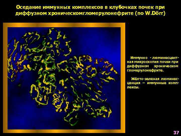 Оседание иммунных комплексов в клубочках почек при диффузном хроническомгломерулонефрите (по W. Dörr) Иммунно -