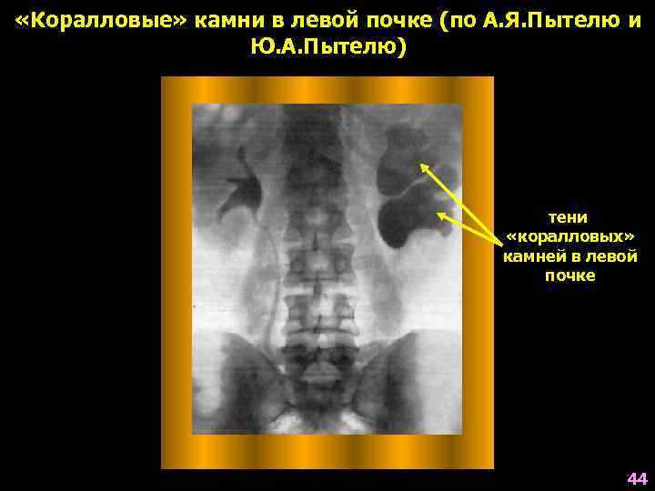  «Коралловые» камни в левой почке (по А. Я. Пытелю и Ю. А. Пытелю)