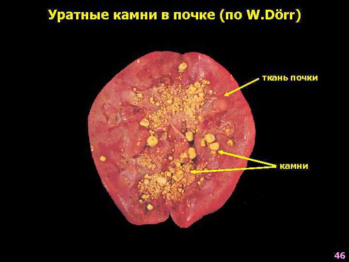 Уратные камни в почке (по W. Dörr) ткань почки камни 46 