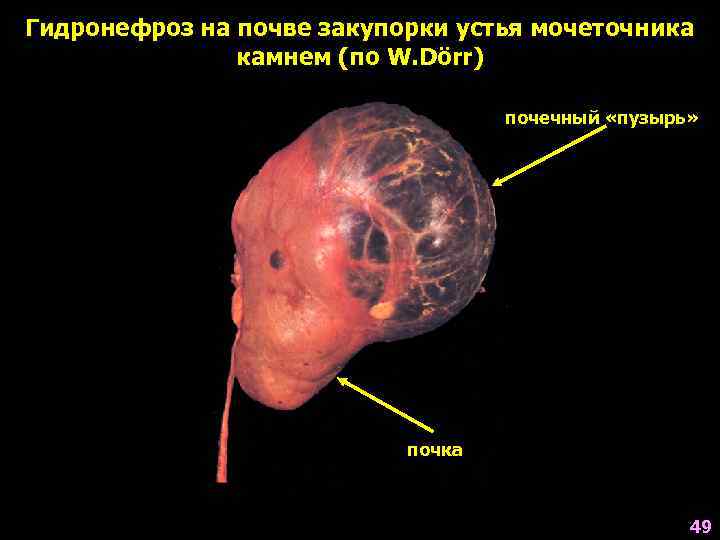 Гидронефроз на почве закупорки устья мочеточника камнем (по W. Dörr) почечный «пузырь» почка 49