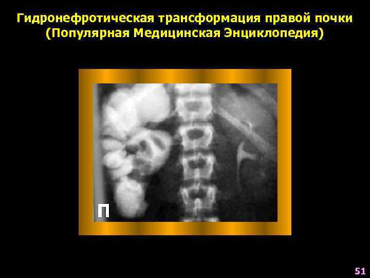 Гидронефротическая трансформация правой почки (Популярная Медицинская Энциклопедия) 51 