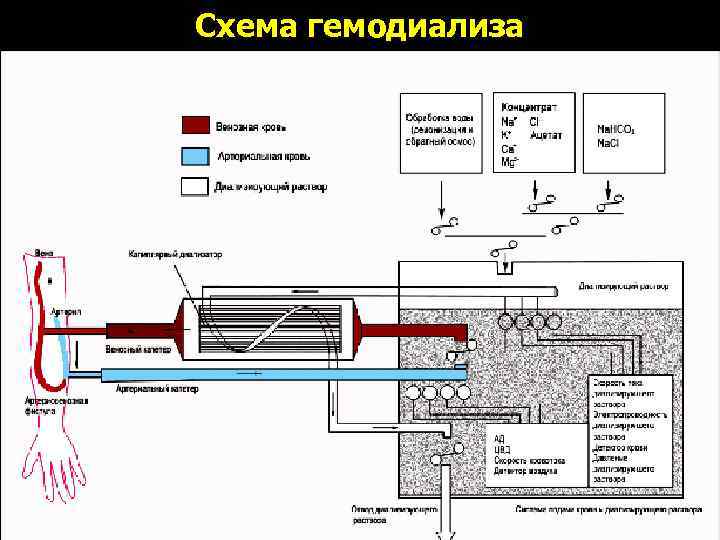 Схема гемодиализа 