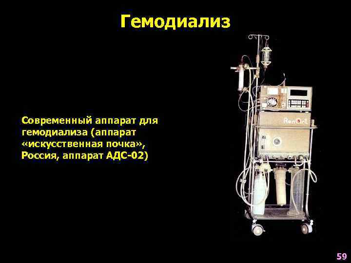 Гемодиализ Современный аппарат для гемодиализа (аппарат «искусственная почка» , Россия, аппарат АДС-02) 59 