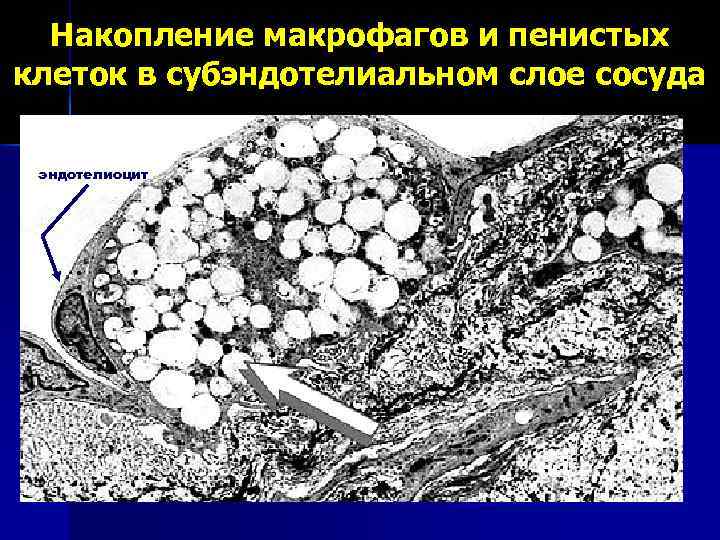 Накопление макрофагов и пенистых клеток в субэндотелиальном слое сосуда эндотелиоцит 