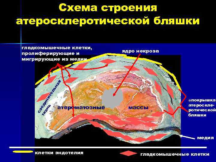 Схема строения атеросклеротической бляшки ядро некроза со тк еди ан н ь ит ел