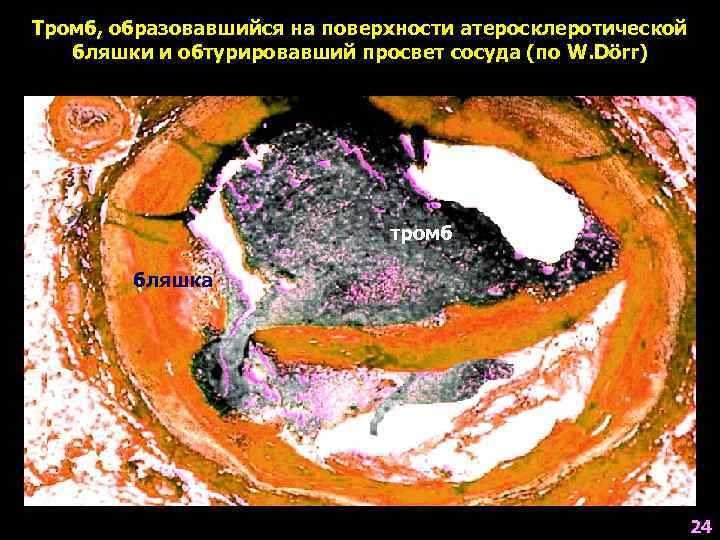 Тромб, образовавшийся на поверхности атеросклеротической бляшки и обтурировавший просвет сосуда (по W. Dörr) тромб