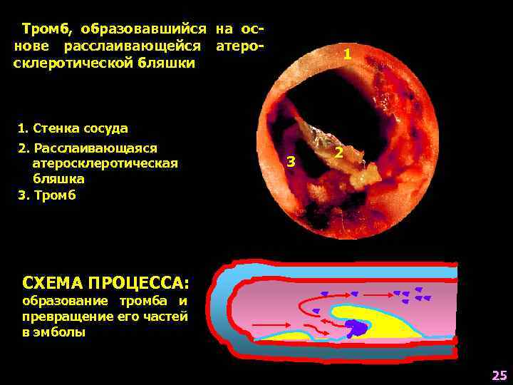 Тромб, образовавшийся на основе расслаивающейся атеросклеротической бляшки 1 1. Стенка сосуда 2. Расслаивающаяся атеросклеротическая