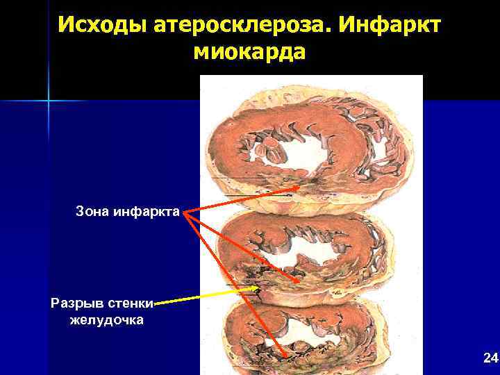 Исходы атеросклероза. Инфаркт миокарда Зона инфаркта Разрыв стенки желудочка 24 