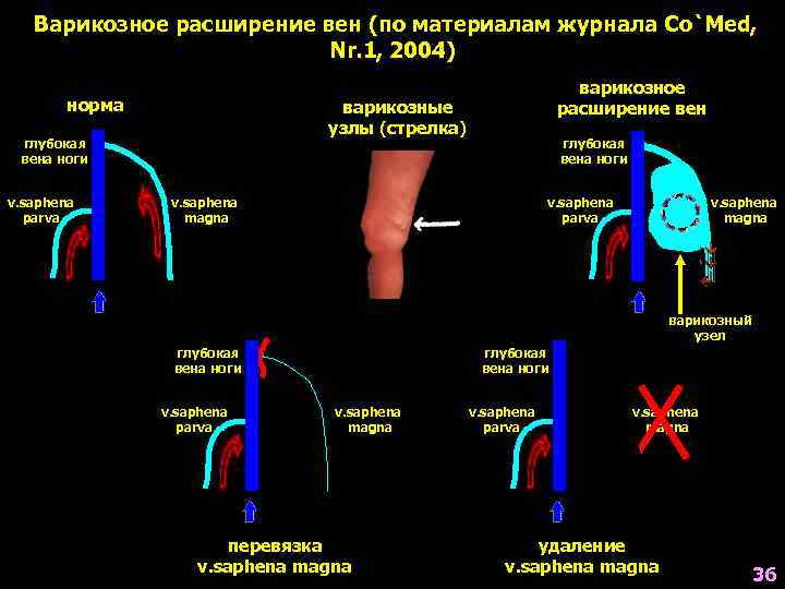 Варикозное расширение вен (по материалам журнала Co`Med, Nr. 1, 2004) норма варикозные узлы (стрелка)