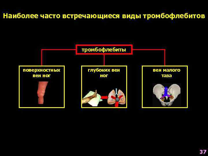 Наиболее часто встречающиеся виды тромбофлебитов тромбофлебиты поверхностных вен ног глубоких вен ног вен малого