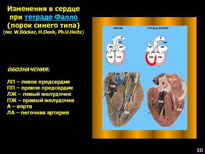 Врожденный порок сердца тетрада фалло презентация