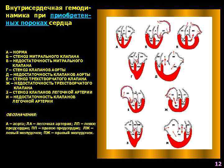 Внутрисердечная гемодинамика приобретенных пороках сердца А – НОРМА Б – СТЕНОЗ МИТРАЛЬНОГО КЛАПАНА В