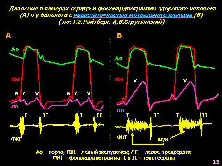 Давление в камерах сердца и фонокардиограммы здорового человека (А) и у больного с недостаточностью