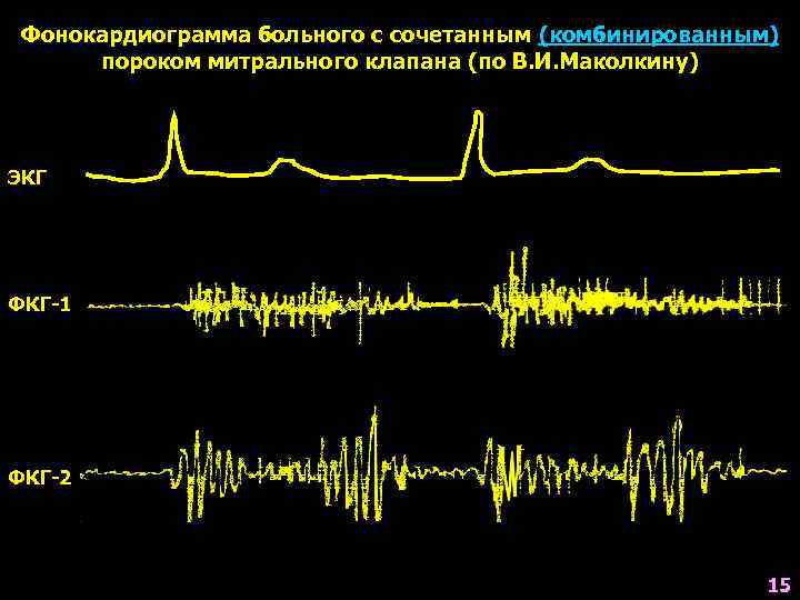 Фонокардиограмма больного с сочетанным (комбинированным) пороком митрального клапана (по В. И. Маколкину) ЭКГ ФКГ-1