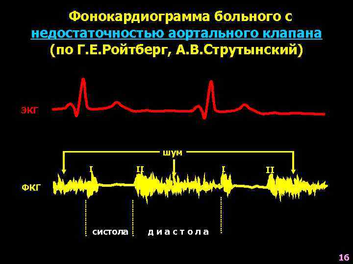 Фонокардиограмма больного с недостаточностью аортального клапана (по Г. Е. Ройтберг, А. В. Струтынский) ЭКГ