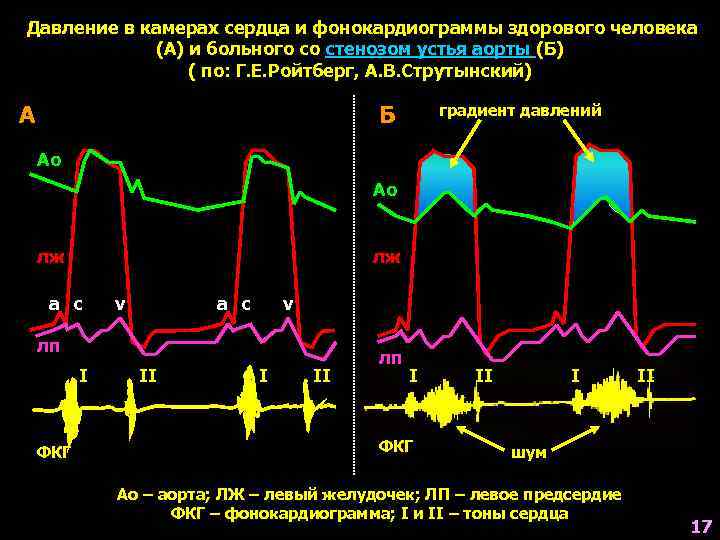 Давление в камерах сердца и фонокардиограммы здорового человека (А) и больного со стенозом устья