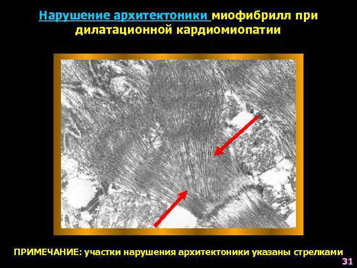 Нарушение архитектоники миофибрилл при дилатационной кардиомиопатии ПРИМЕЧАНИЕ: участки нарушения архитектоники указаны стрелками 31 