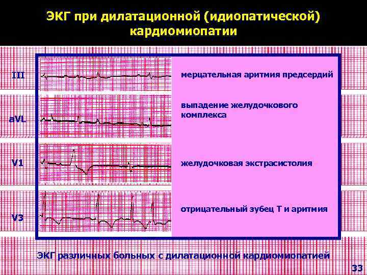 Экг при дилатационной кардиомиопатии фото