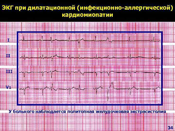 Экг при дилатационной кардиомиопатии фото