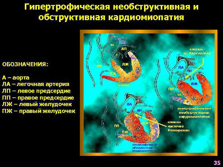 Гипертрофическая необструктивная и обструктивная кардиомиопатия ОБОЗНАЧЕНИЯ: А – аорта ЛА – легочная артерия ЛП