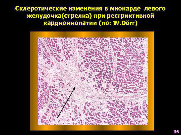 Склеротические изменения в миокарде левого желудочка(стрелка) при рестриктивной кардиомиопатии (по: W. Dörr) 36 