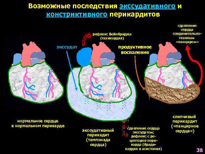 Тампонада сердца презентация