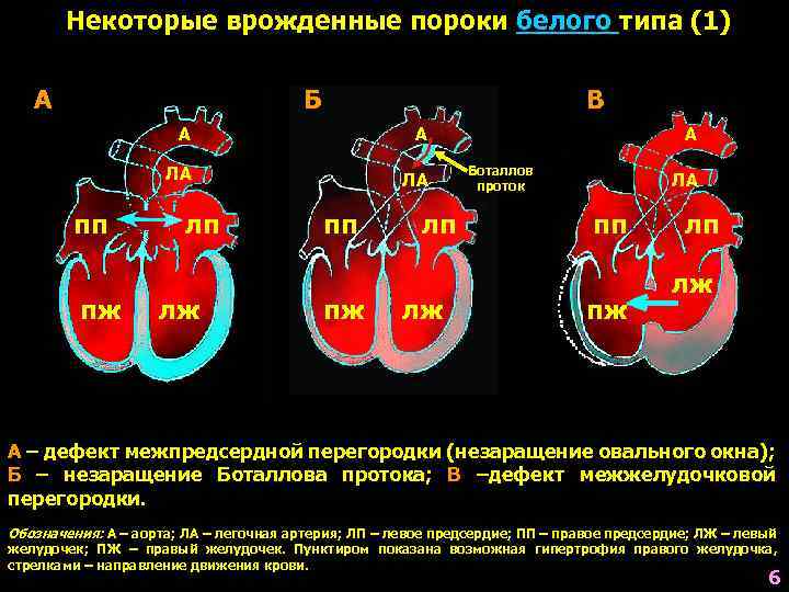 Некоторые врожденные пороки белого типа (1) А Б В А ЛА пп пж А