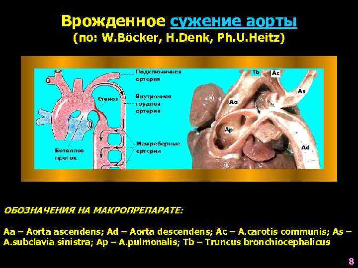 Врожденное сужение аорты (по: W. Böcker, H. Denk, Ph. U. Heitz) ОБОЗНАЧЕНИЯ НА МАКРОПРЕПАРАТЕ: