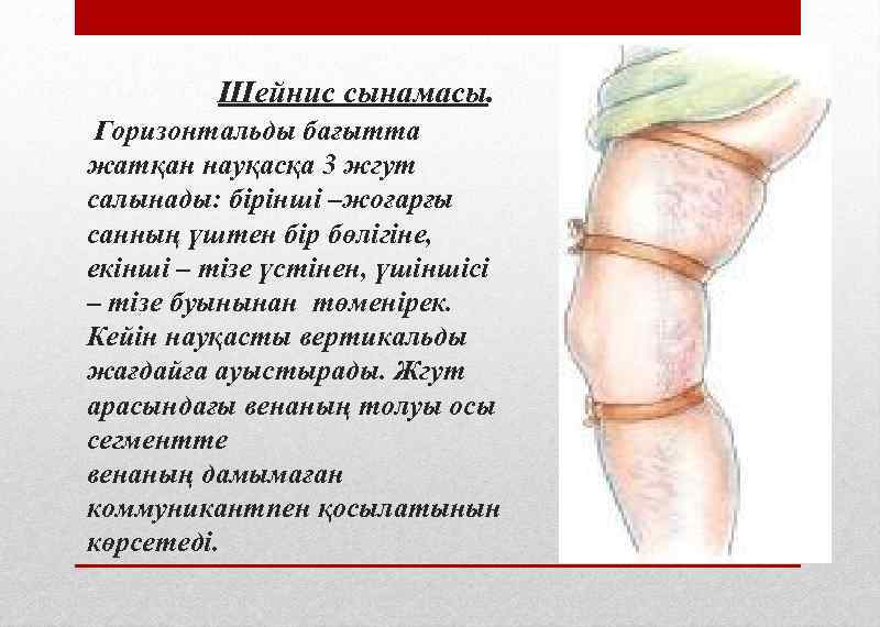 Шейнис сынамасы. Горизонтальды бағытта жатқан науқасқа 3 жгут салынады: бірінші –жоғарғы санның үштен бір