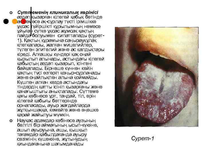 ¢ ¢ Сүттеменің клиникалық көрінісі аздап қызарған кілегей қабық бетінде ақ немесе ақ-сұрлау түсті