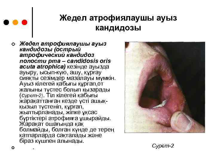 Жедел атрофиялаушы ауыз кандидозы ¢ ¢ Жедел атрофиялаушы ауыз кандидозы (острый атрофический кандидоз полости