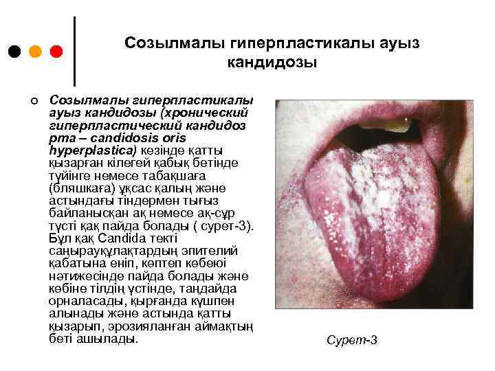 Созылмалы гиперпластикалы ауыз кандидозы ¢ Созылмалы гиперпластикалы ауыз кандидозы (хронический гиперпластический кандидоз рта –