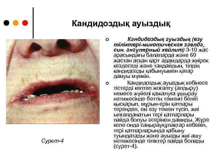 Кандидоздық ауыздық ¢ ¢ Сурет-4 Кандидоздық ауыздық (езу тіліктері-микотическая заелда, син. ангулярный хейлит) 3