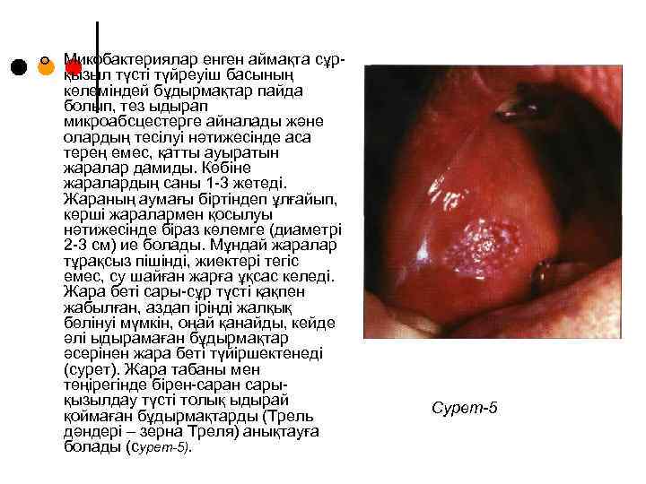 ¢ Микобактериялар енген аймақта сұрқызыл түсті түйреуіш басының көлеміндей бұдырмақтар пайда болып, тез ыдырап