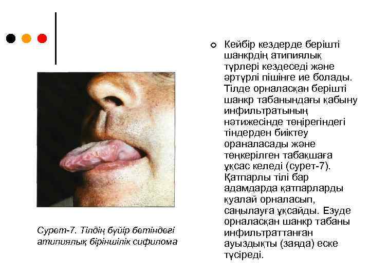 ¢ Сурет-7. Тілдің бүйір бетіндегі атипиялық біріншілік сифилома Кейбір кездерде берішті шанкрдің атипиялық түрлері