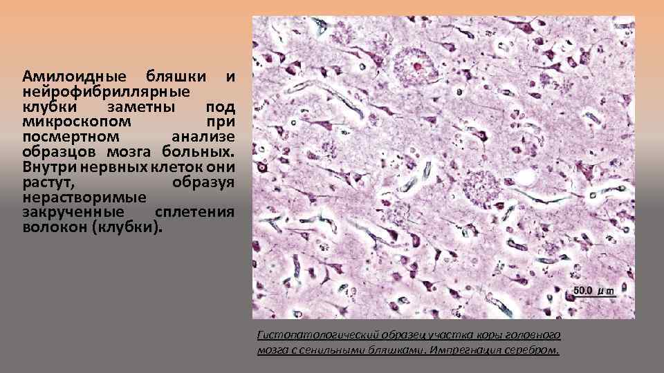 Посмертный анализ. Болезнь Альцгеймера амилоидные бляшки. Сенильные бляшки гистология. Бета амилоидные бляшки. Нейрофибриллярные клубки болезнь Альцгеймера.