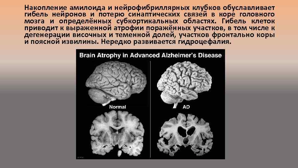 Признаки атрофии мозга. Атрофия головного мозга патанатомия. Атрофия коры головного мозга. Гибель клеток головного мозга. Отмирание коры головного мозга.