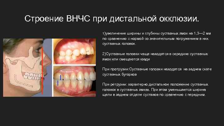 Строение ВНЧС при дистальной окклюзии. 1)увеличение ширины и глубины суставных ямок на 1, 3—