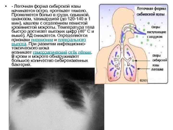  • - Легочная форма сибирской язвы начинается остро, протекает тяжело. Проявляется болью в