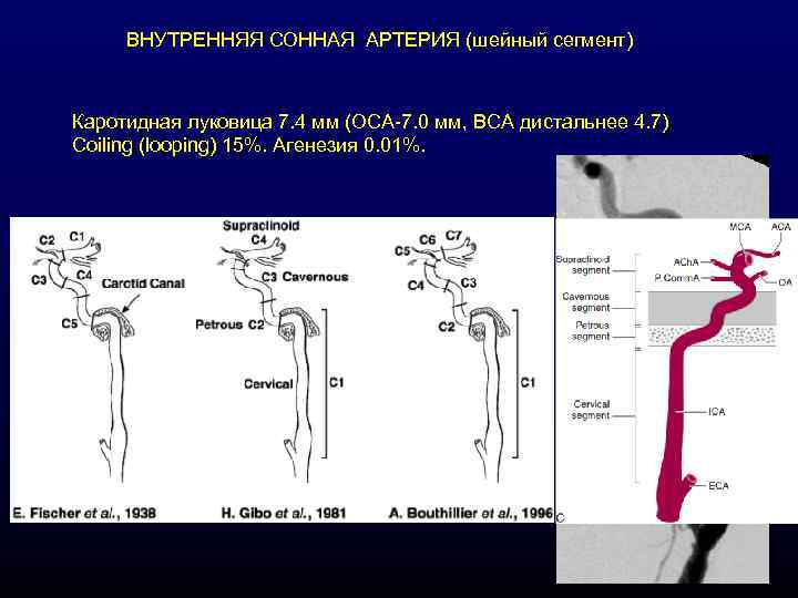 ВНУТРЕННЯЯ СОННАЯ АРТЕРИЯ (шейный сегмент) Каротидная луковица 7. 4 мм (ОСА-7. 0 мм, ВСА