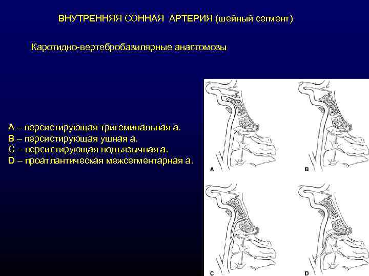 ВНУТРЕННЯЯ СОННАЯ АРТЕРИЯ (шейный сегмент) Каротидно-вертебробазилярные анастомозы А – персистирующая тригеминальная а. В –