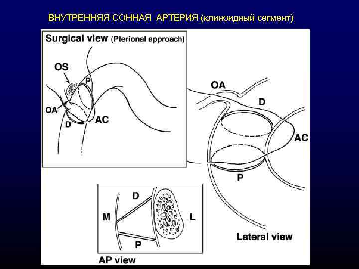 ВНУТРЕННЯЯ СОННАЯ АРТЕРИЯ (клиноидный сегмент) 