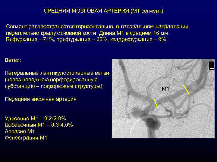 СРЕДНЯЯ МОЗГОВАЯ АРТЕРИЯ (М 1 сегмент) Сегмент распространяется горизонтально, в латеральном направлении, параллельно крылу