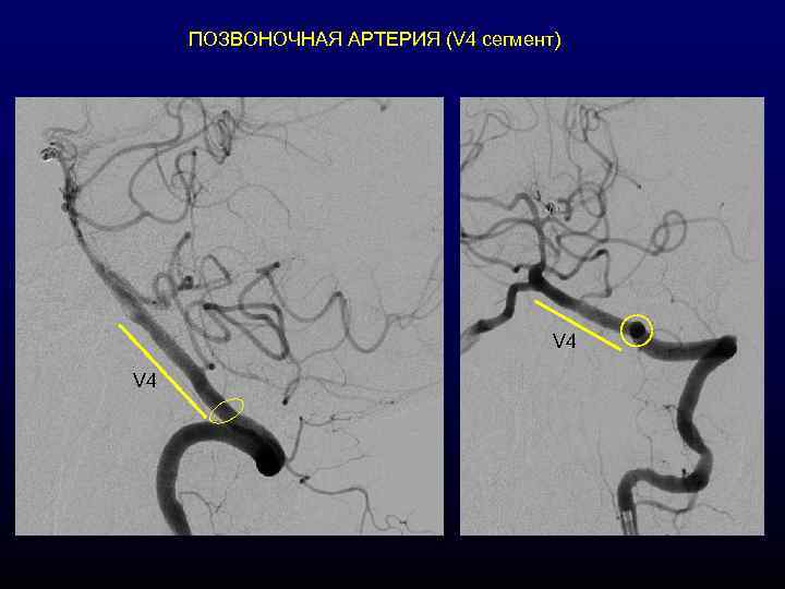 ПОЗВОНОЧНАЯ АРТЕРИЯ (V 4 сегмент) V 4 