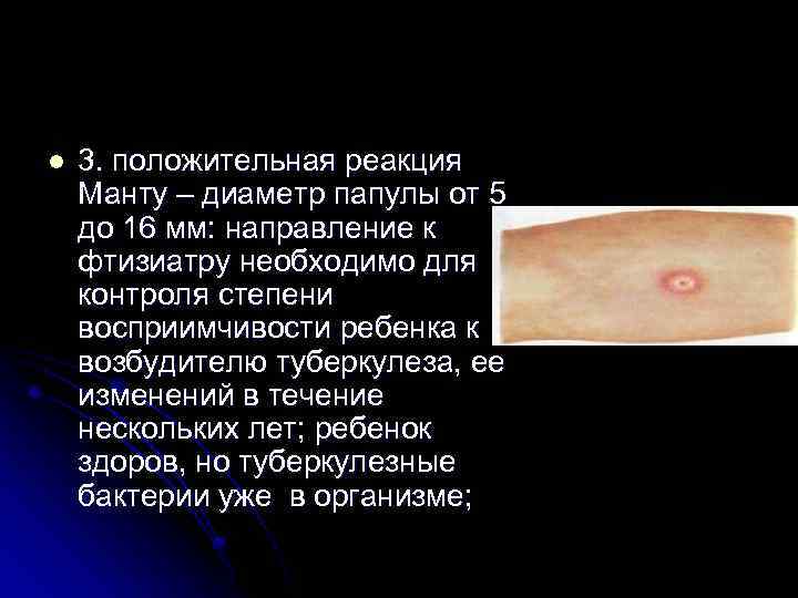l 3. положительная реакция Манту – диаметр папулы от 5 до 16 мм: направление