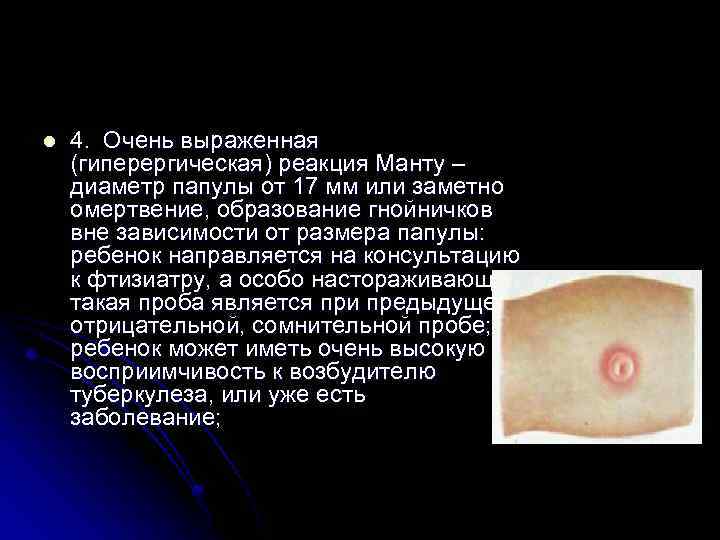 l 4. Очень выраженная (гиперергическая) реакция Манту – диаметр папулы от 17 мм или
