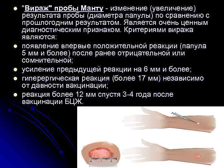 l l l "Вираж" пробы Манту - изменение (увеличение) результата пробы (диаметра папулы) по